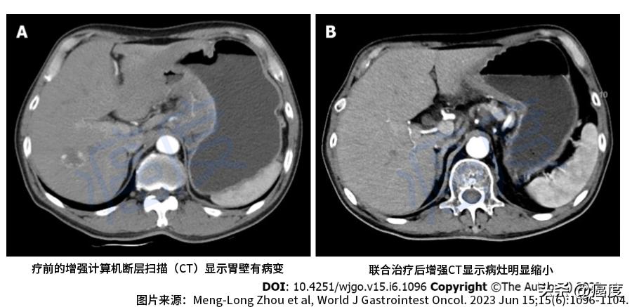 最新胃癌特效药,最新的胃癌化疗方案