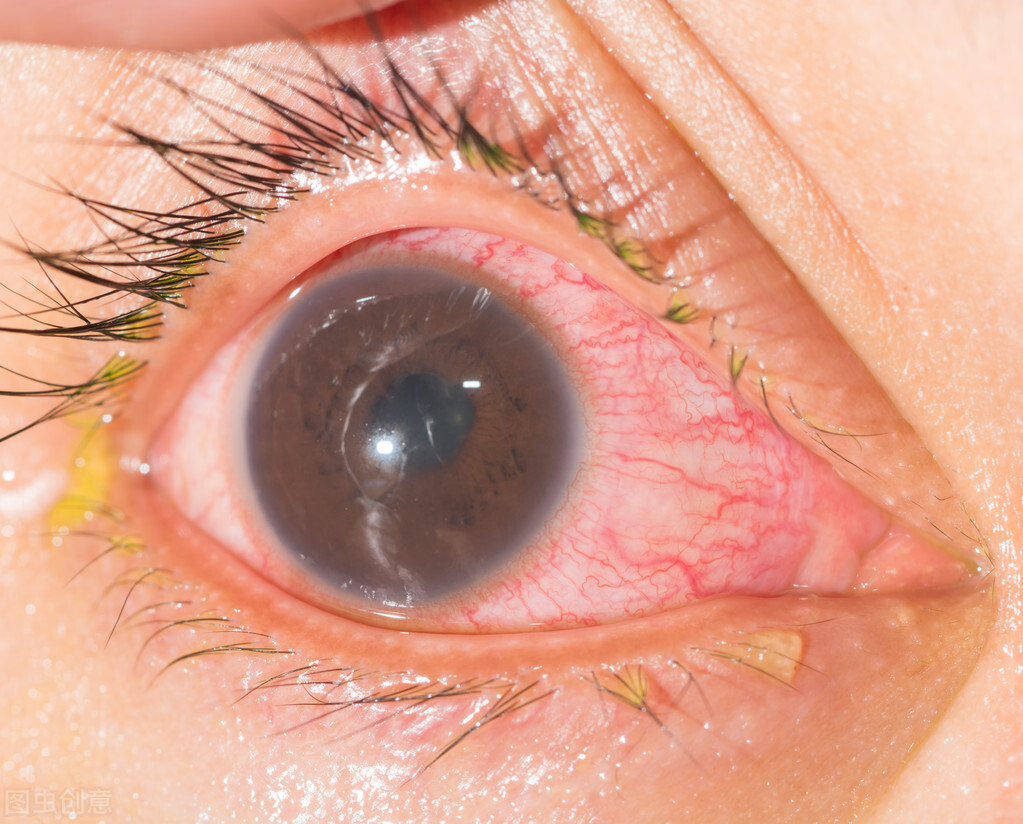 如果眼睛里有血丝会怎样啊,眼睛有血丝一般大概多久会消失