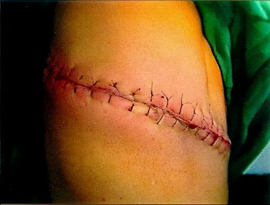 肾结石不疼不代表没有危害，一旦发现要及时就诊！