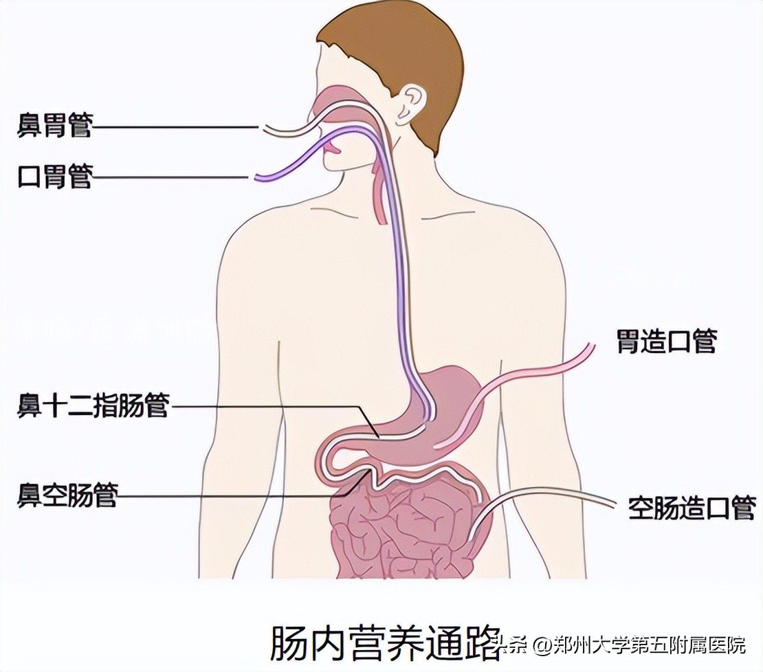 肠内营养患者腹泻的处理,为什么喝肠内营养粉剂腹泻