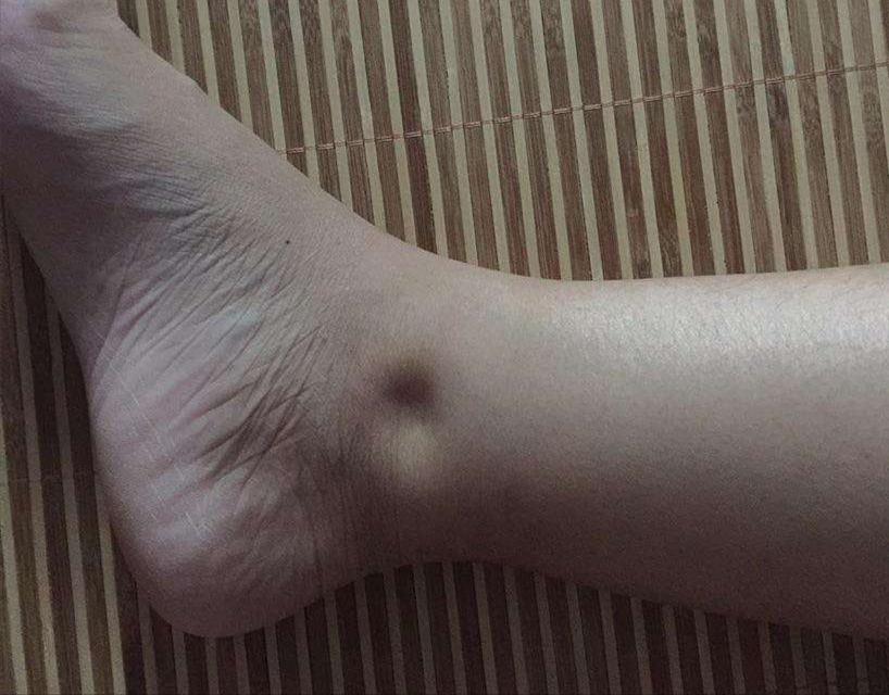 喝红豆水能消除水肿吗,为什么会水肿怎么消水肿