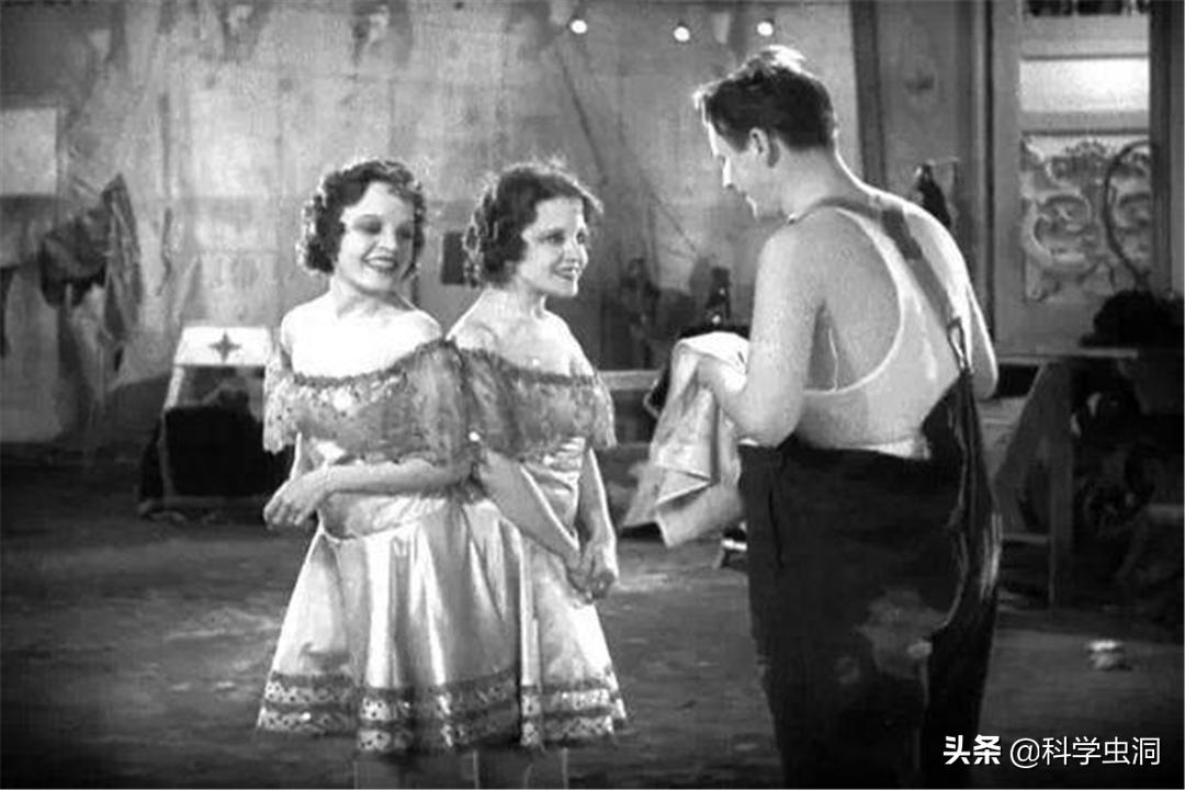 连体姐妹其中一个人死了怎么办,连体姐妹一个死了另一个咋办