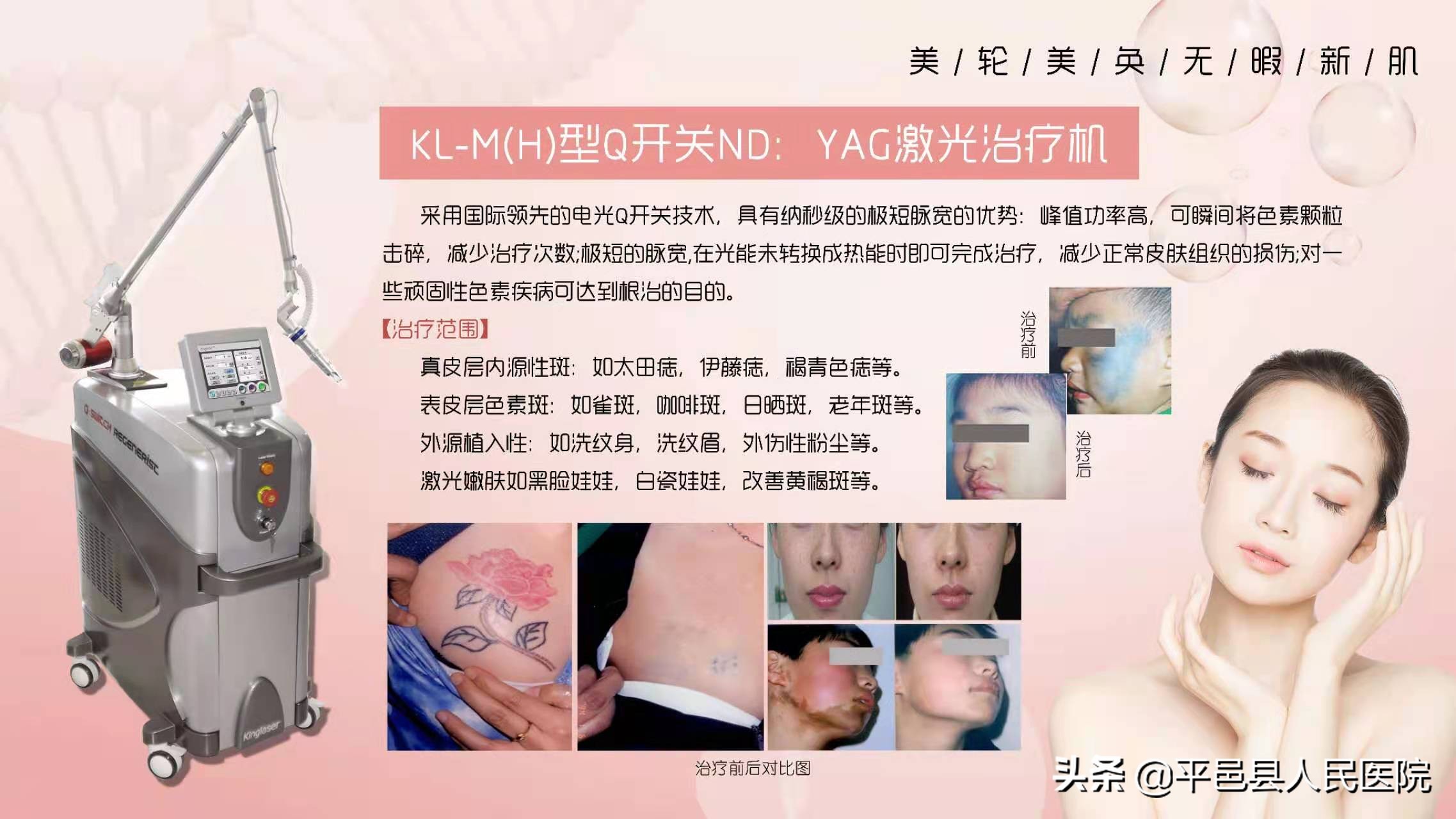 号外|让您“旧貌焕新颜”平邑县人民医院皮肤科引进调Q激光治疗仪