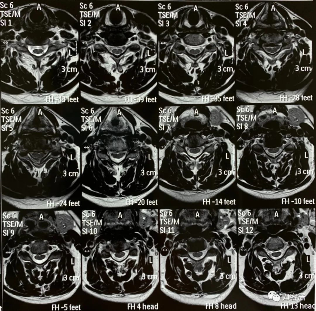 右手拇指间歇性麻木，颈椎病，颈椎失稳的保守治疗