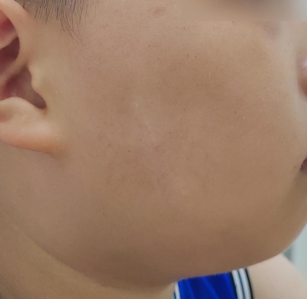 黑毛痣去掉还会长毛吗,黑毛痣到哪里可以去掉