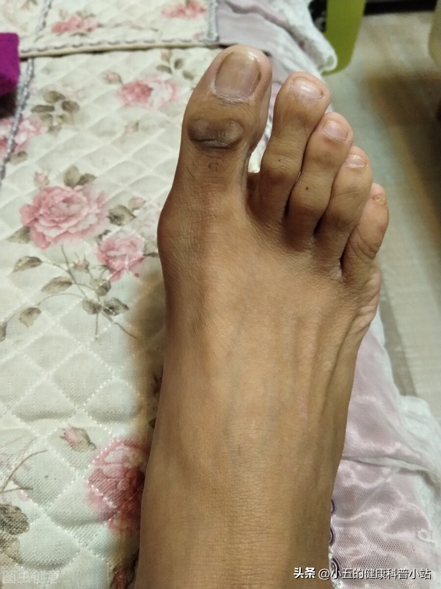 吃苯溴马隆降尿酸痛风发作怎么办,苯溴马隆治疗尿酸高效果怎么样