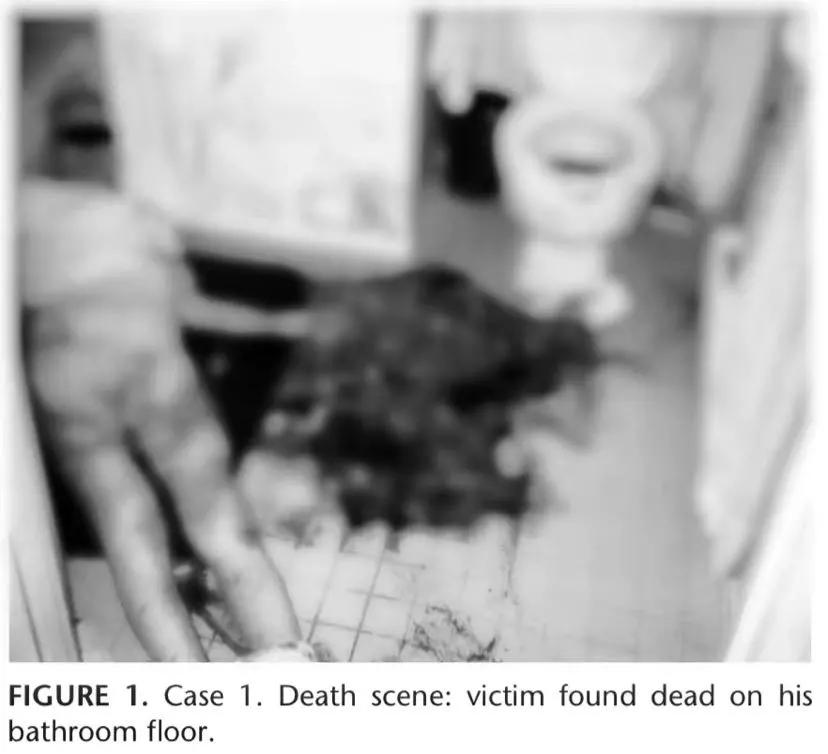 静脉曲张导致肺栓塞的案例,静脉曲张导致的血栓案例