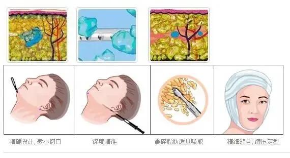 面部吸脂会影响酒窝吗,面部吸脂多久彻底消肿