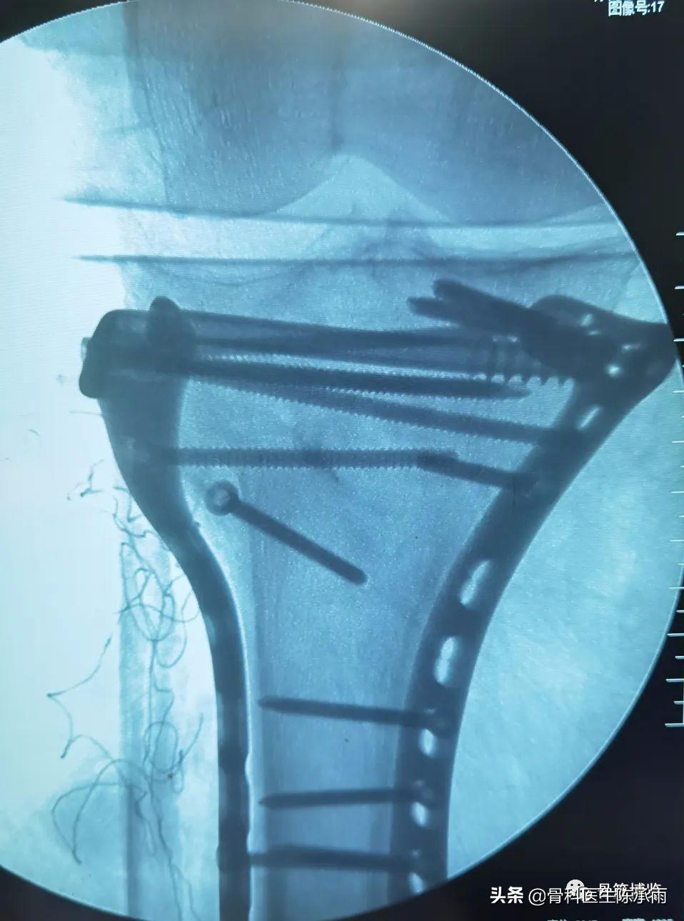 陈旧性腿骨骨折,陈旧性骨折
