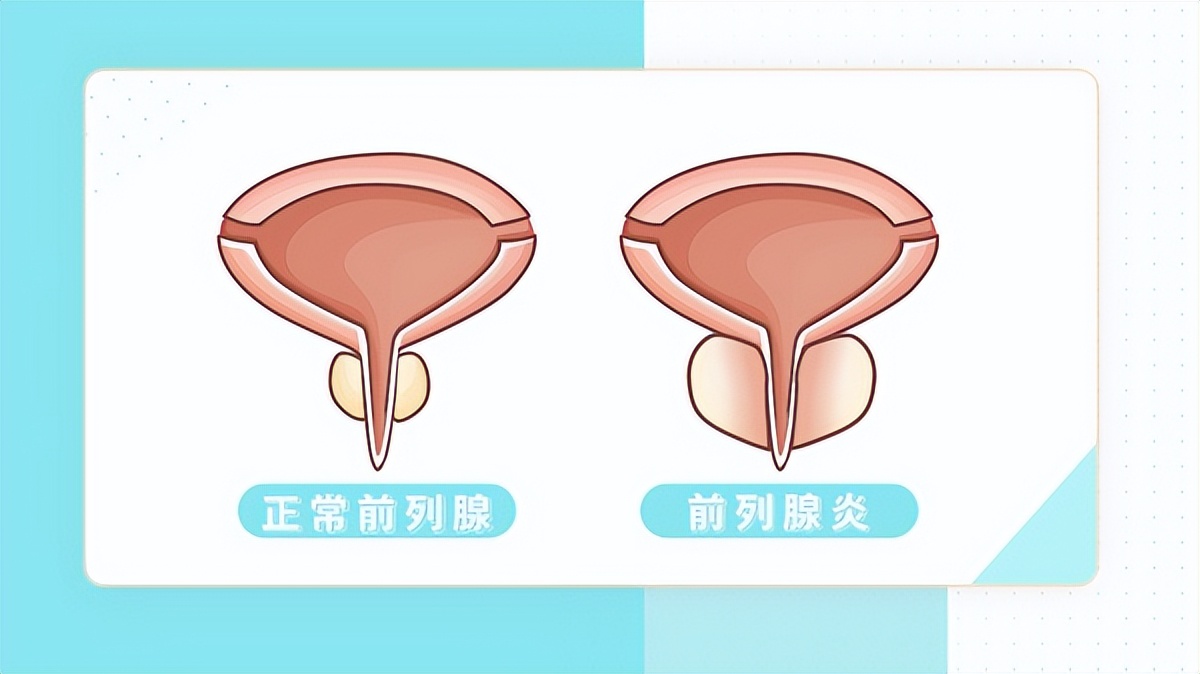 前列腺炎无菌性和细菌感染区别,前列腺炎有细菌会感染女朋友吗