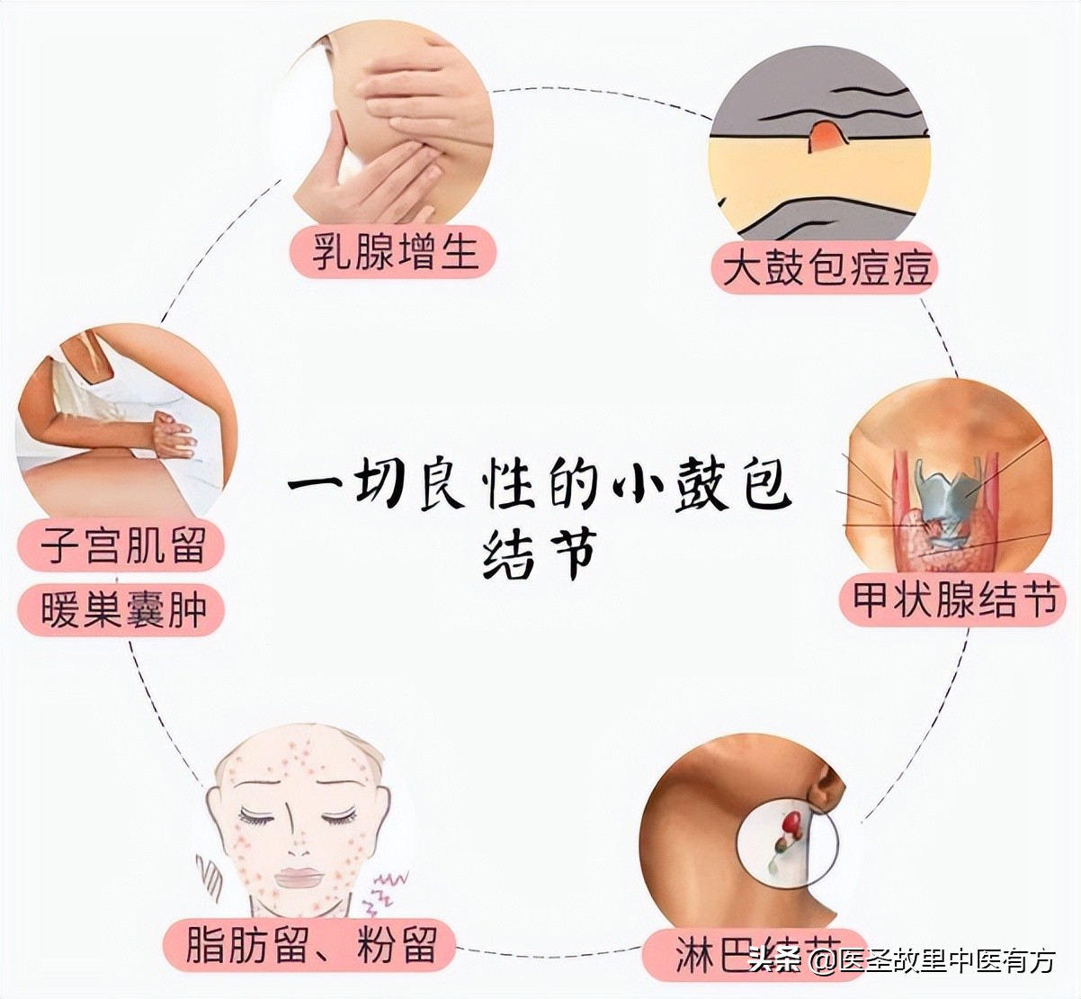 痰湿三味中药克星,治疗痰湿结节包块的一张秘方