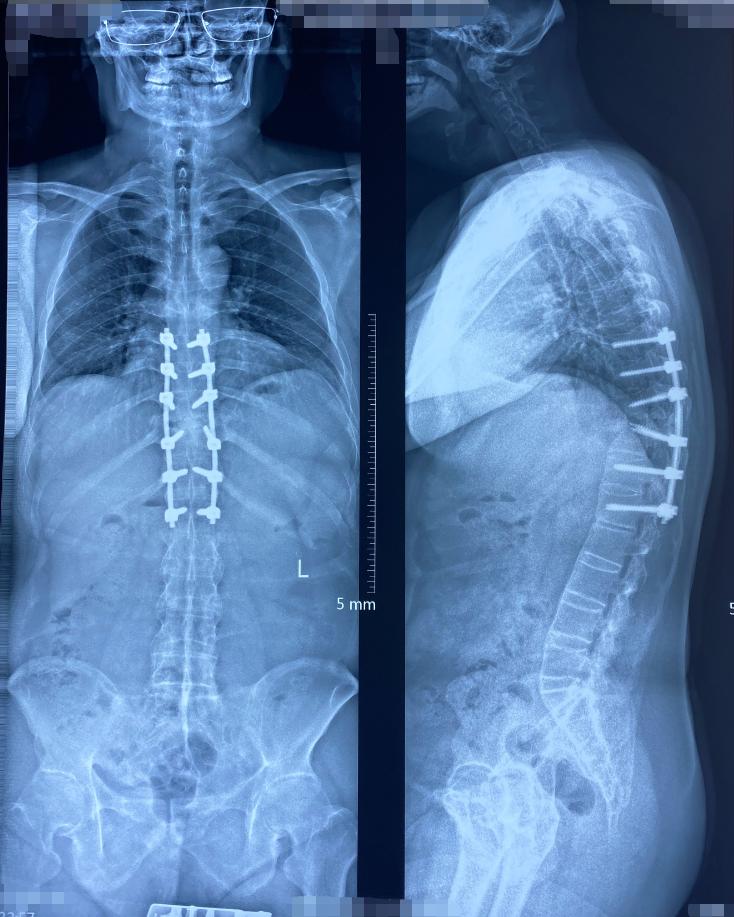 强直性脊柱炎骨折自愈,强直性脊柱炎骨折能恢复好吗