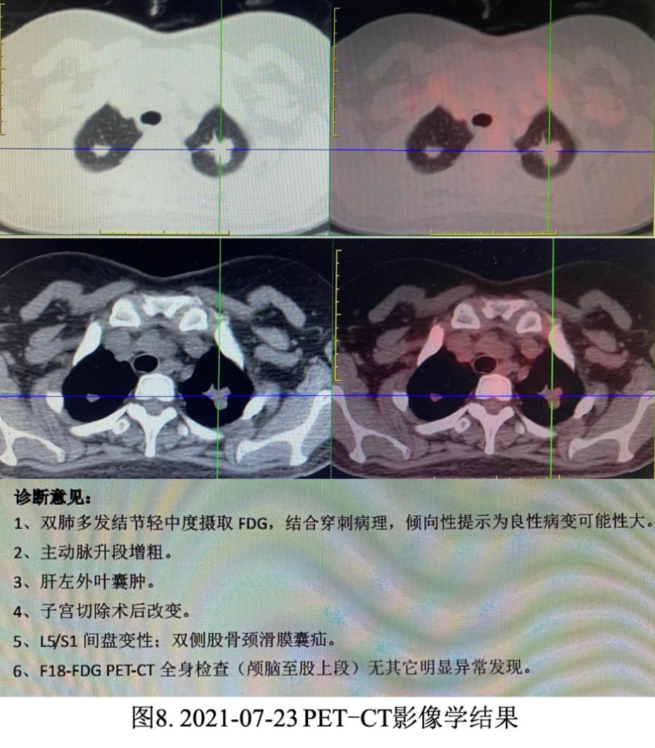 妇女双肺多发结节，病理示炎症，病情持续进展如何揭疑？