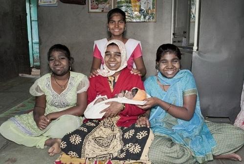 故事:非洲17岁女孩长满络腮胡,毛发从鼻孔长到脖子,身体有何异常