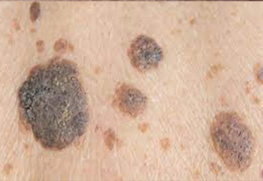 耳朵边有颗大痣这个位置会病变吗,什么样的痣容易癌变不能点