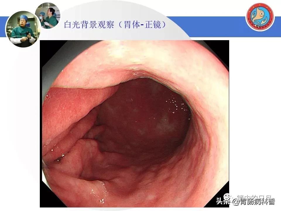 胃癌可以做内镜手术吗,早期胃癌内镜手术后追加外科手术