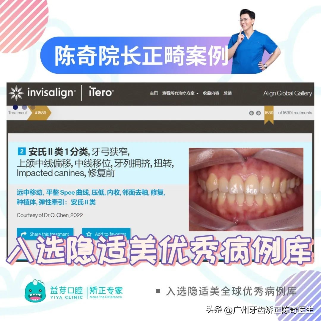 正畸治疗的基本矫治方法,正畸修复联合案例