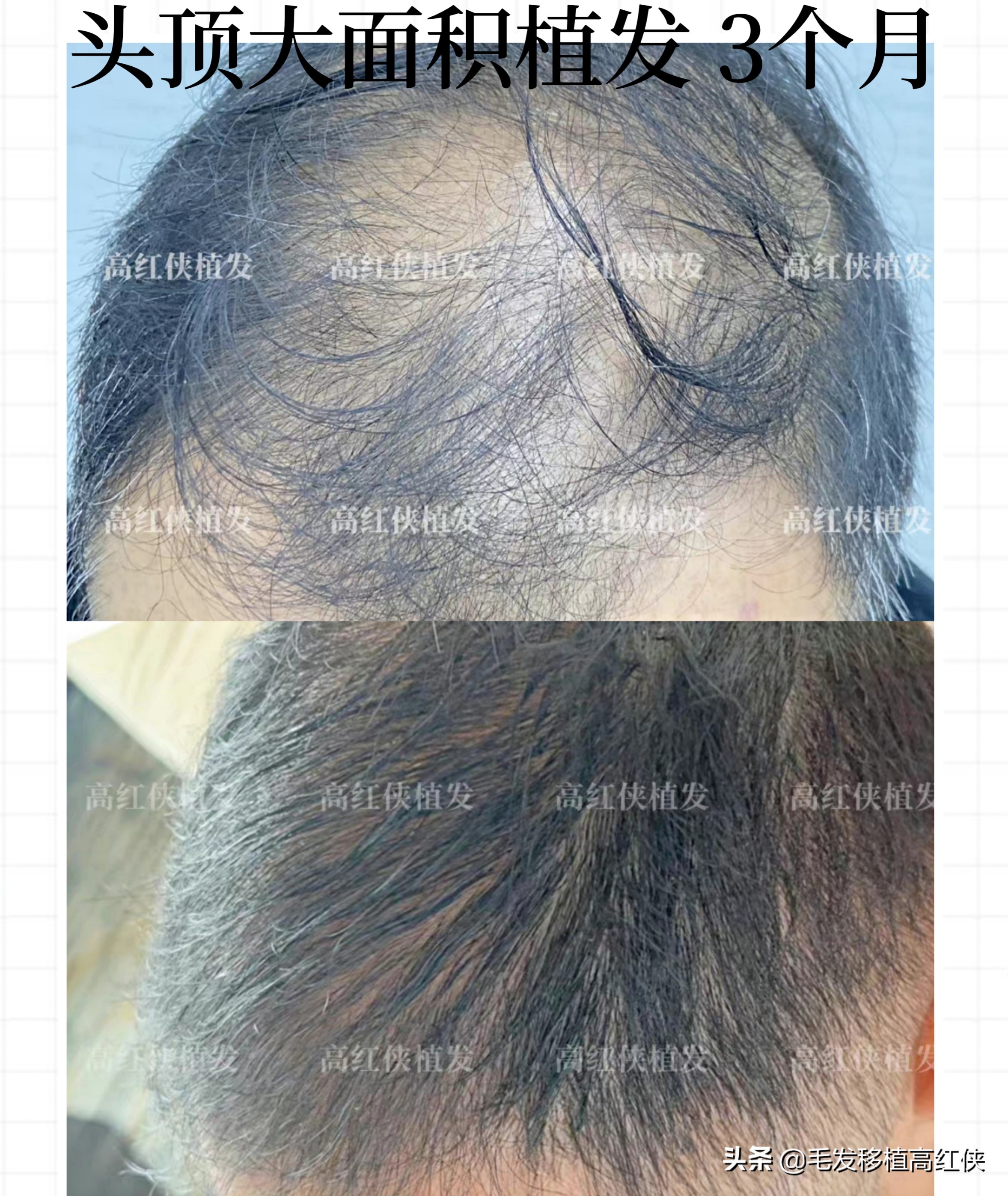 头顶大面积秃顶适合植发么,女生头顶秃顶植发