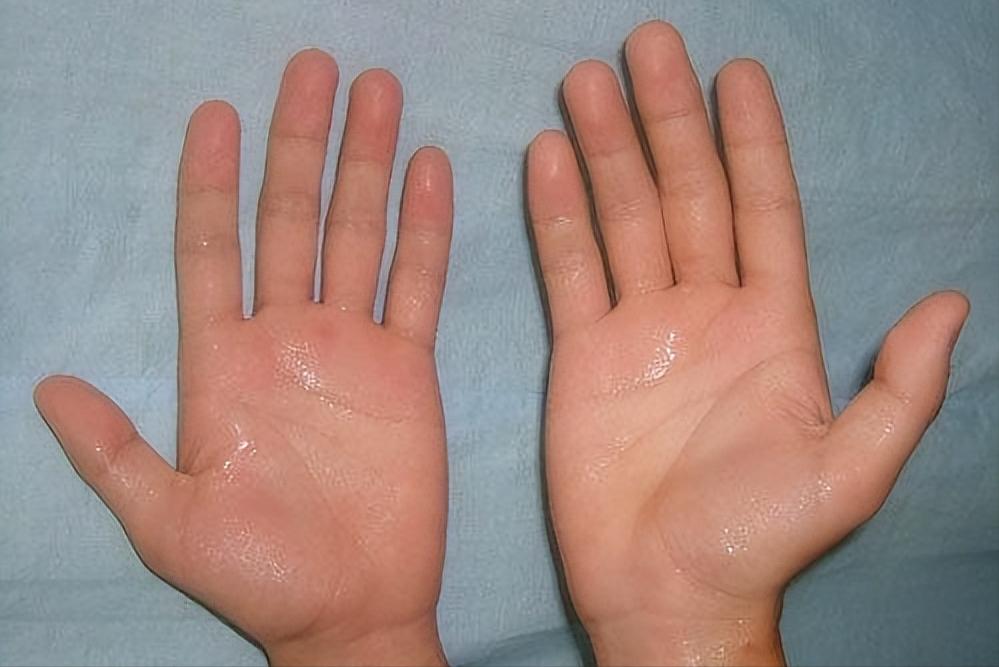 脾虚头汗湿热教你一招正确止汗,头汗多是气虚还是湿热