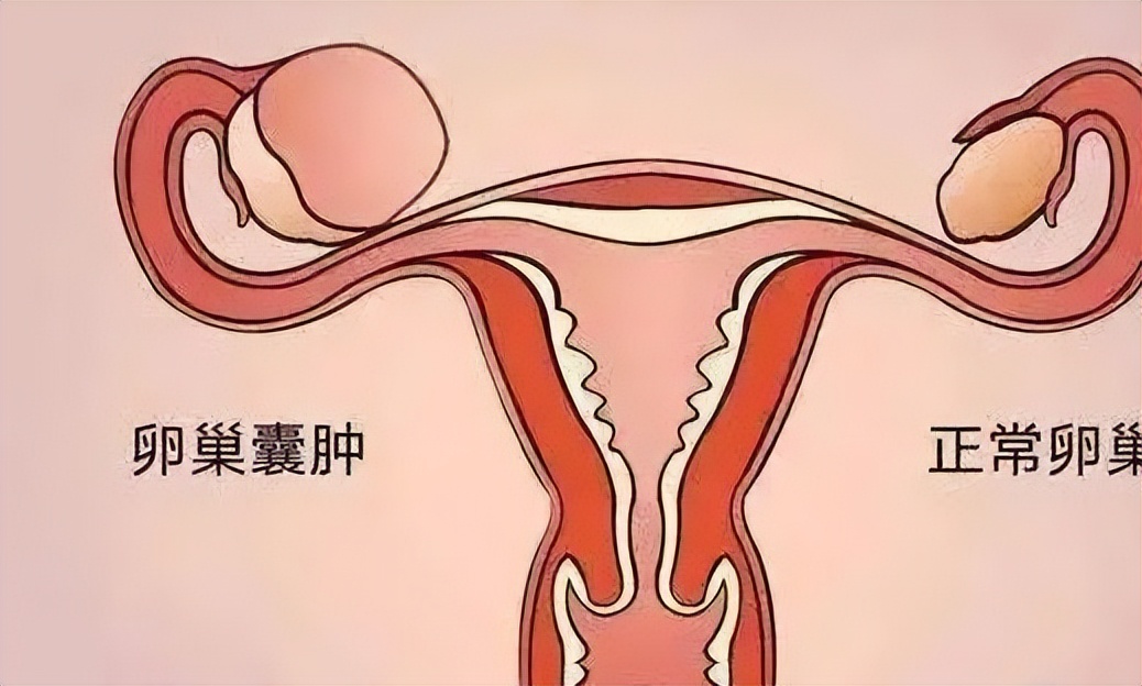 医生说有个囊肿是怎么回事,医生说囊肿是良性的但是需要手术