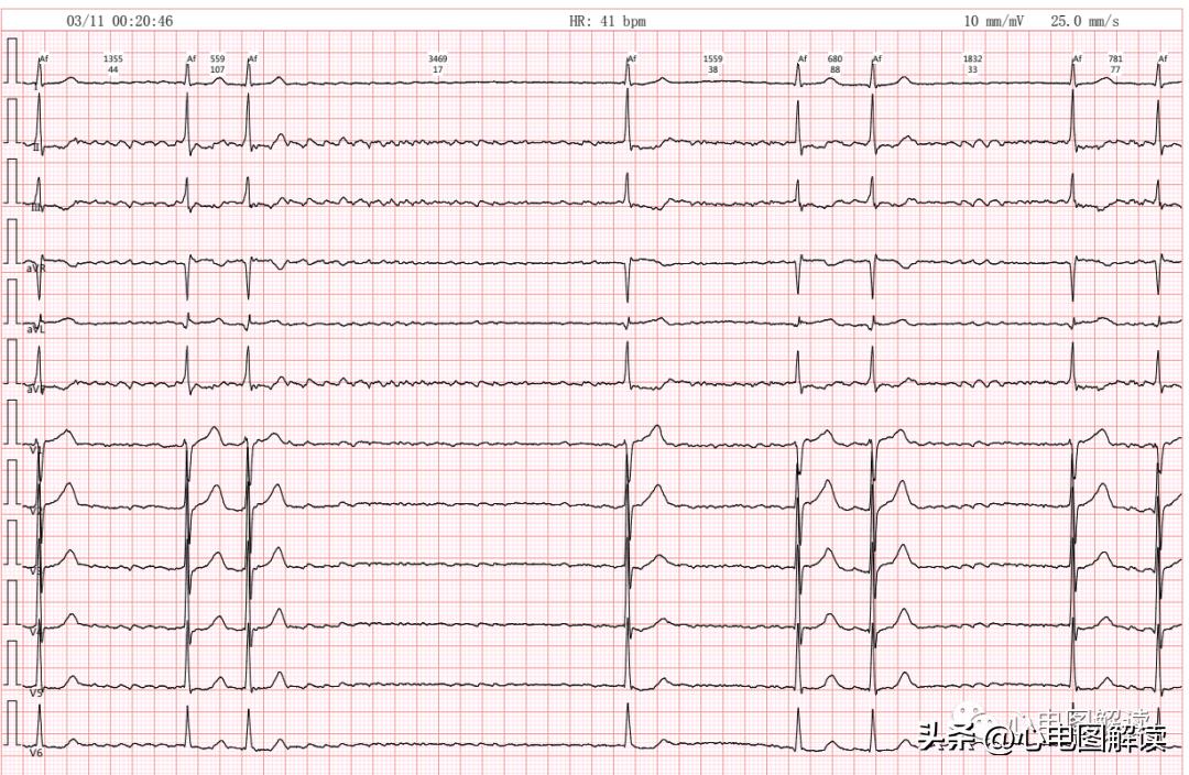 心房颤动伴长间歇心电图,心房颤动伴长间歇是什么意思