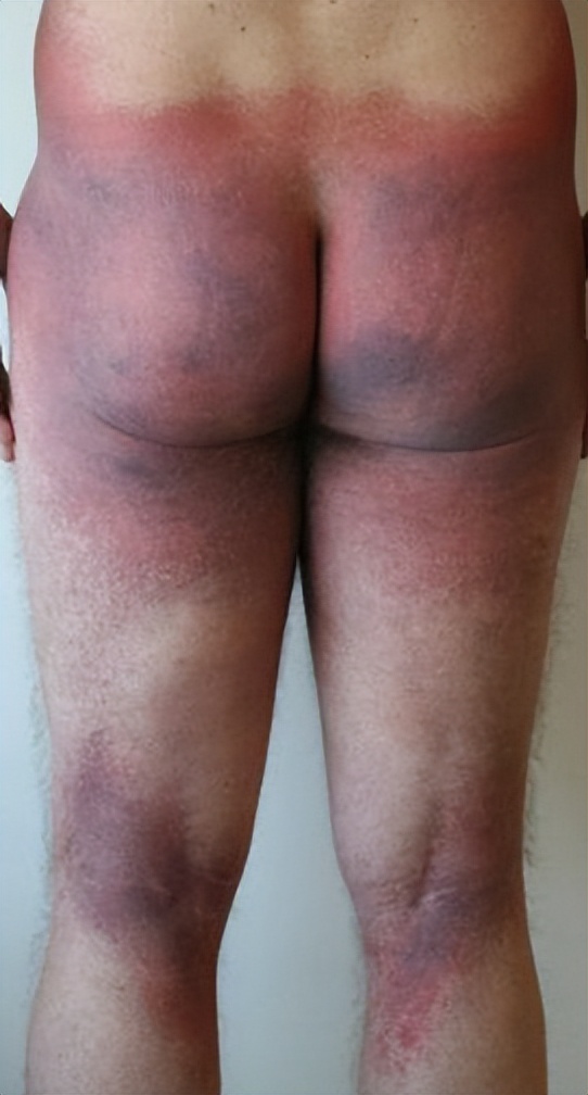 药物反应引起皮肤瘙痒,吃药后皮肤出现药疹