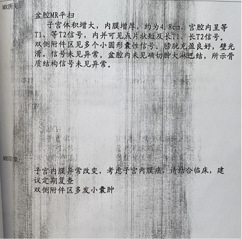 子宫内膜癌现在一直流血,子宫内膜增厚流血是癌吗