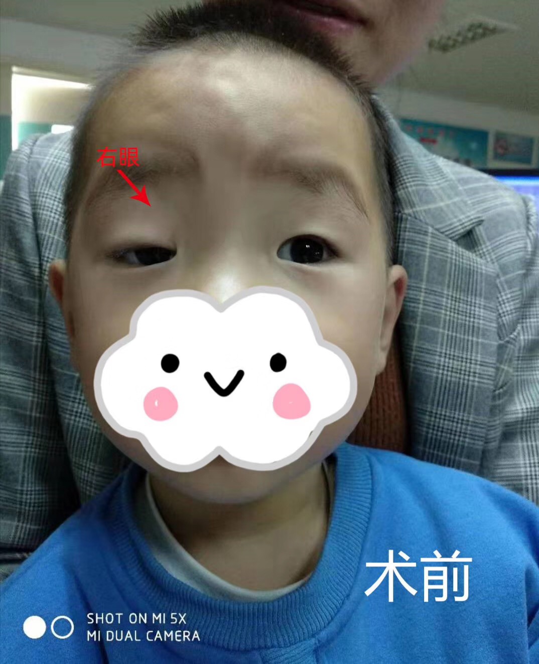 眼睛一大一小的解决方法,眼睛一大一小严重怎么办