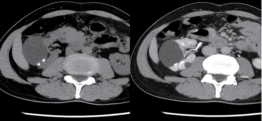 明知山有虎,偏向虎山行——肾斗士VS肾结石