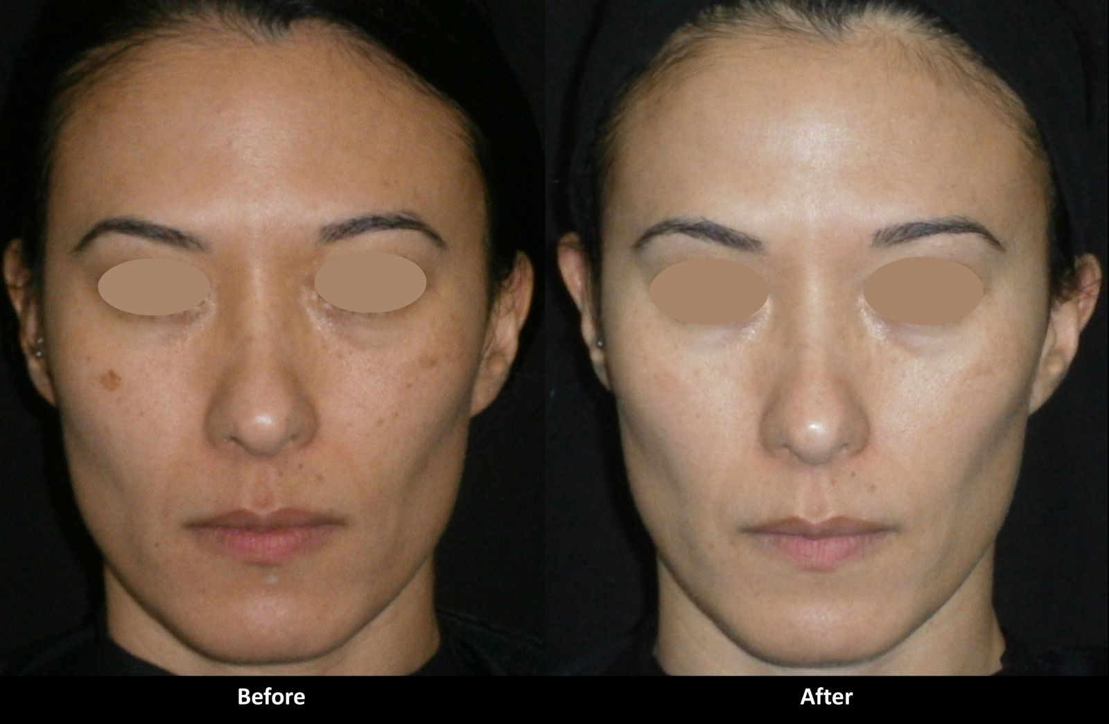 点阵激光和光子嫩肤哪个副作用小,光子嫩肤是什么作用和功效呢