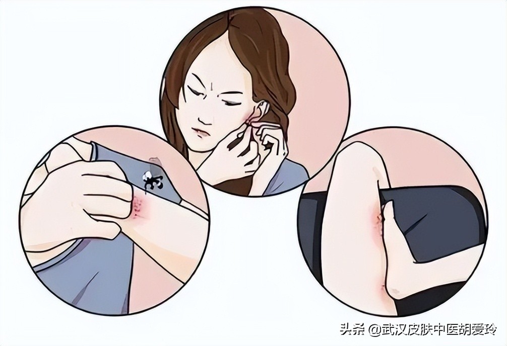 皮肤圆圈形红斑脱皮,身上起红色斑块中间脱皮