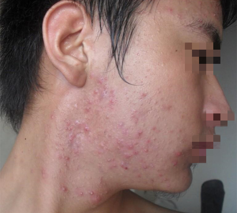 孩子起痘自卑不自信该怎么引导,孩子长青春痘不自信怎么引导