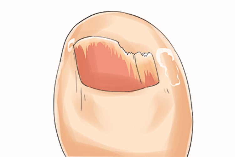 指甲提示疾病图片加介绍,指甲出现哪4种情况是癌症的征兆