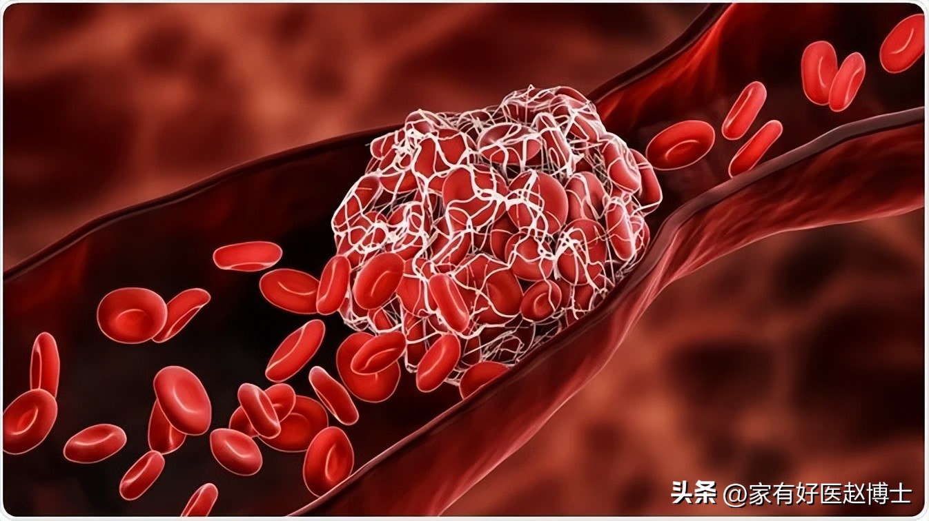 放了心脏支架如果支架坏了咋办,放了心脏支架为什么要抗凝血