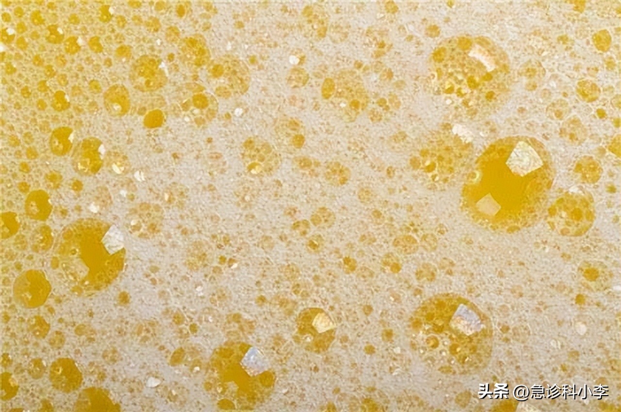 肾衰会小便次数多尿少吗,肾衰前兆