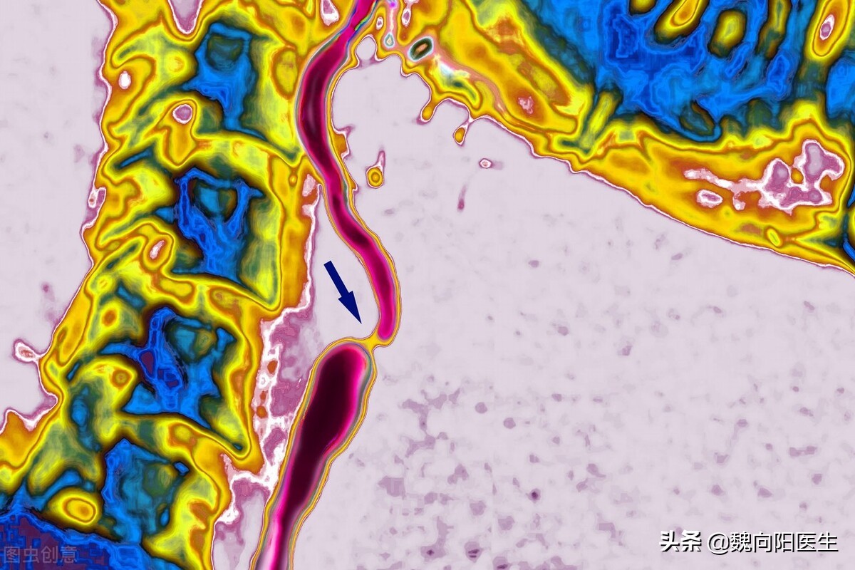 颈静脉血栓能完全溶掉吗,颈动脉血栓能用针管抽吗