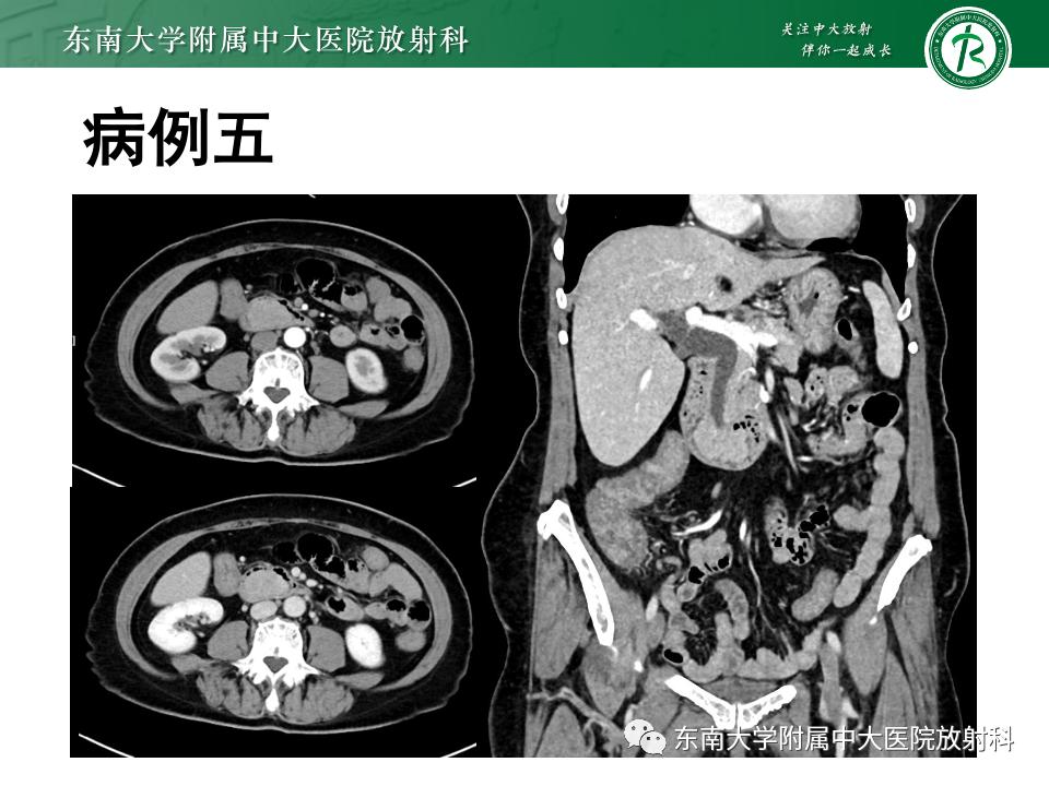 小肠间质瘤最新治疗中药方,小肠间质瘤基因检测