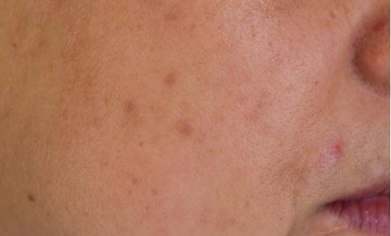 出现色斑应该及时治疗,色斑怎样消除