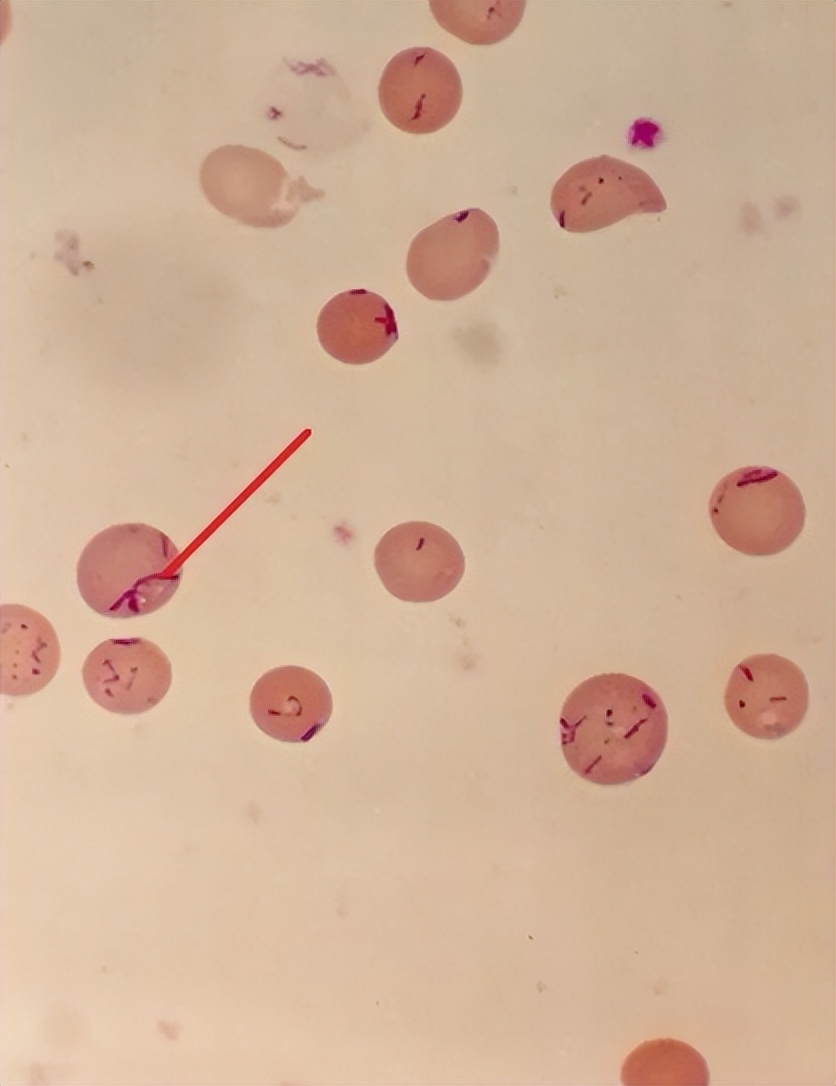 腋窝长了硬块是艾滋病吗,腋下有肿块有可能是艾滋病吗