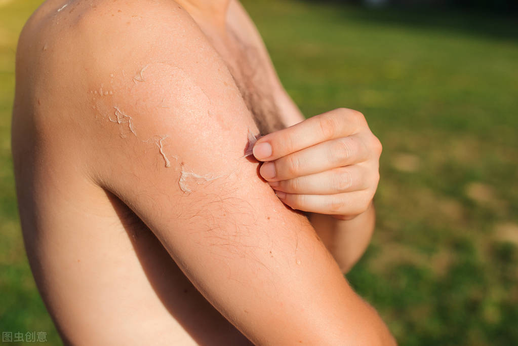 晒伤了怎么办?教你8个方法快速缓解晒伤症状