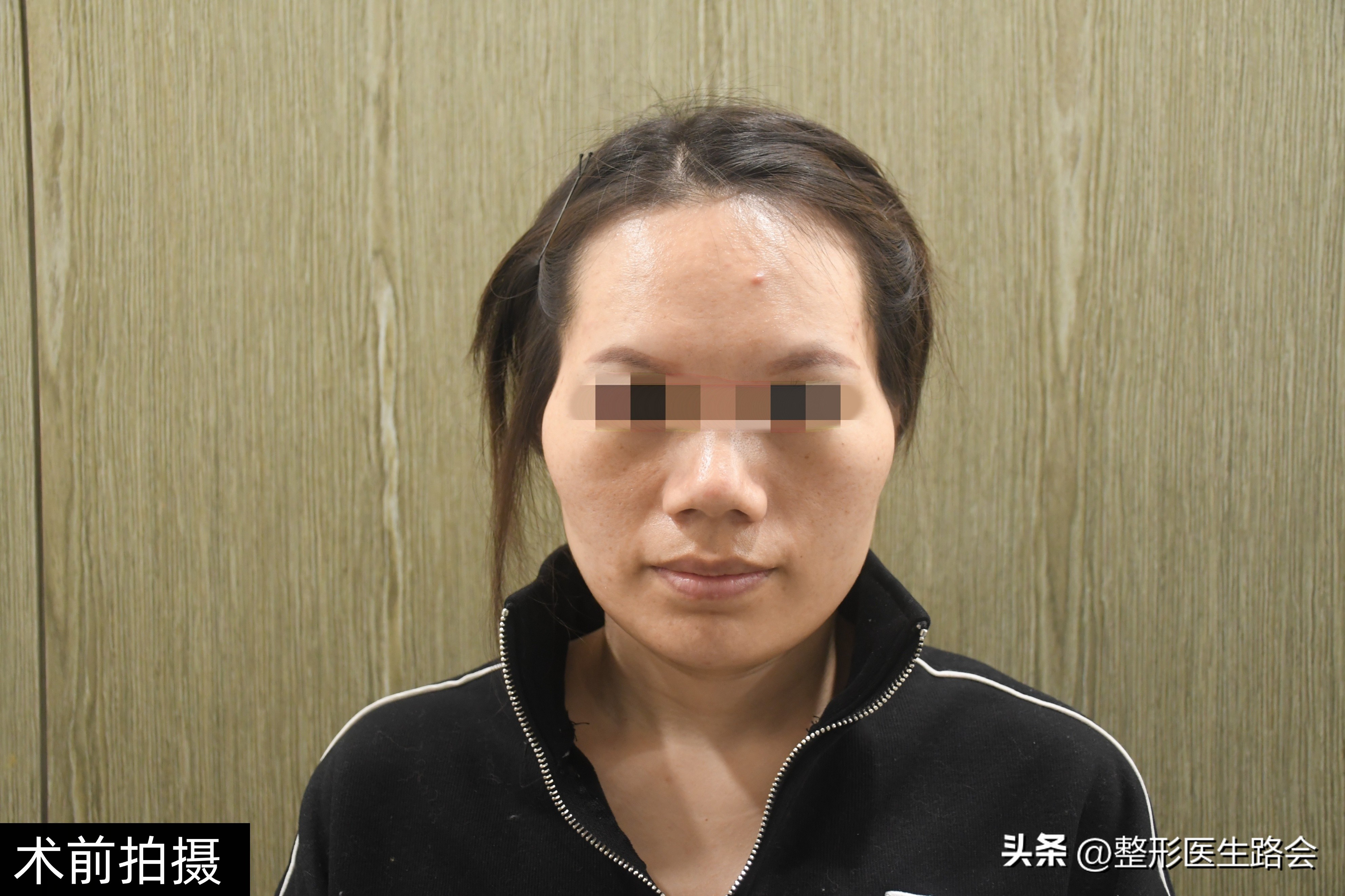 31岁做太阳穴填充,太阳穴填充手术流程