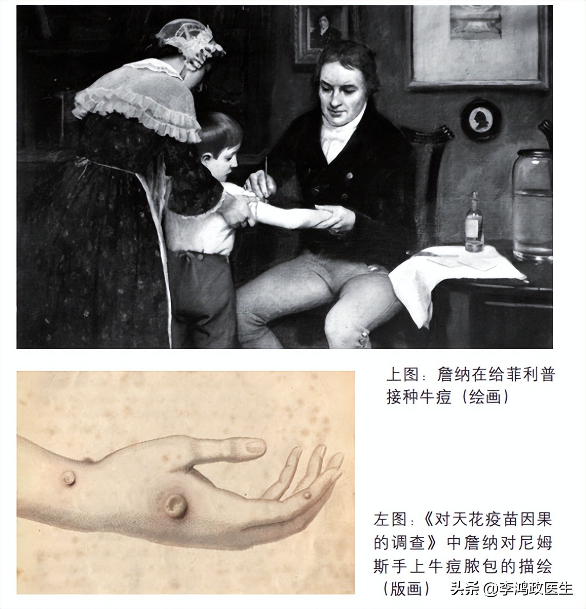 天花目前还未被人类彻底消灭吗,天花不是被灭了吗