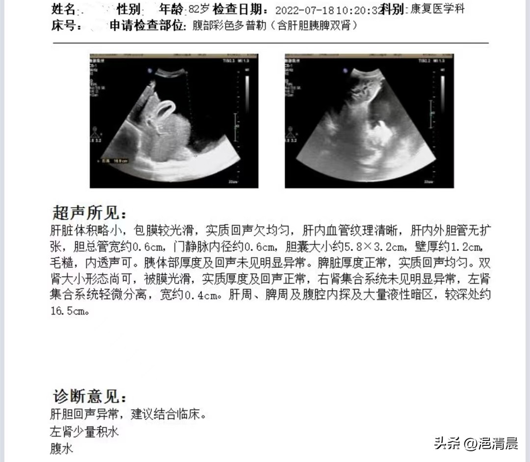 针对恶性腹水，腹腔灌注化疗显奇效