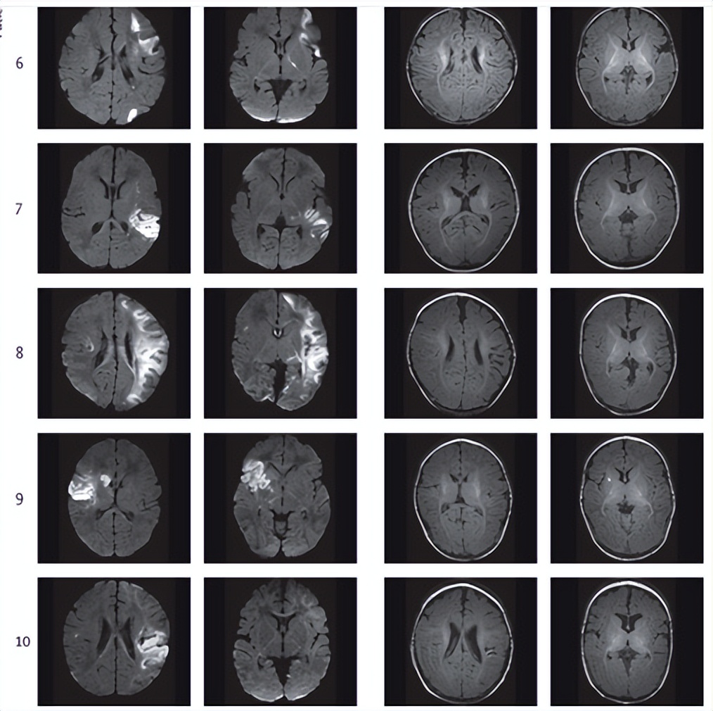 柳叶刀最新：10名中风新生儿接受了干细胞治疗，有望终身受益