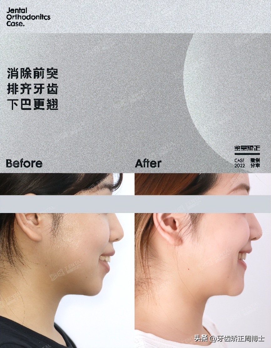 低角面型下巴前倾正畸案例,露龈笑嘴凸下巴后缩