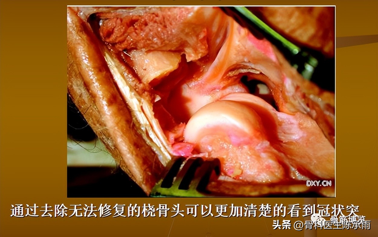 肘关节恐怖三联征最新治疗方法,肘关节恐怖三联征最佳治疗方法