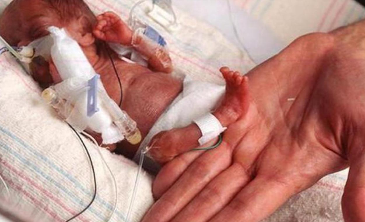 拇指姑娘出生时只有10公分,拇指姑娘出生时仅280克长大