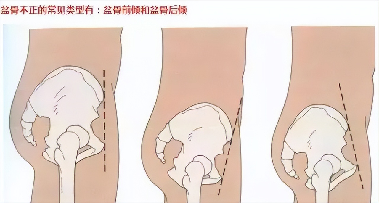 骨盆旋移症就是骨盆不正,怀疑骨盆不正查什么科