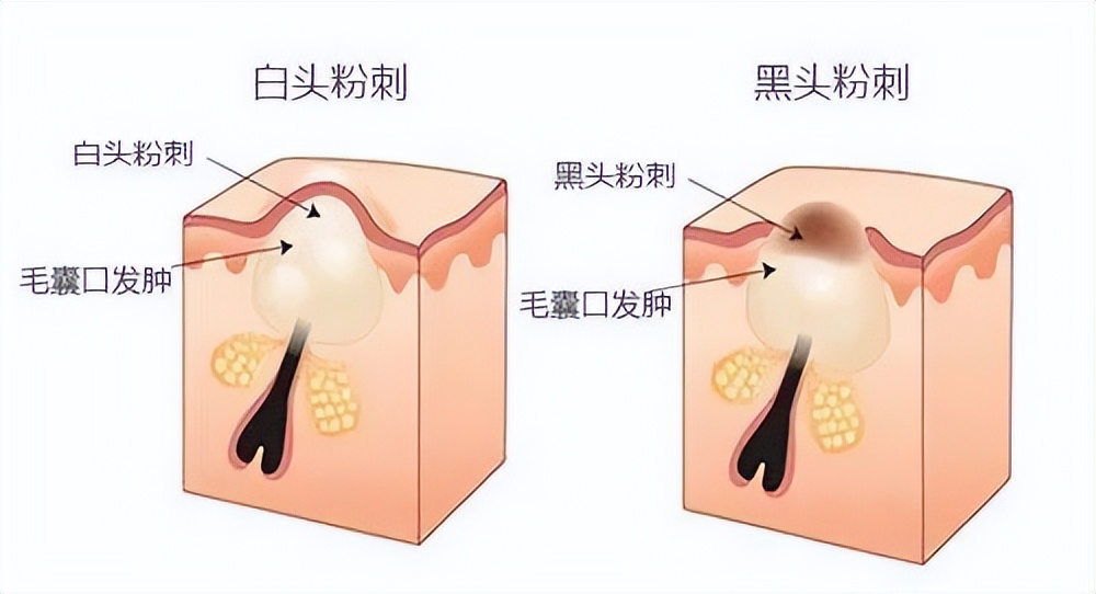 去黑头粉刺去闭口的护肤品,黑头闭口粉刺应该如何清理