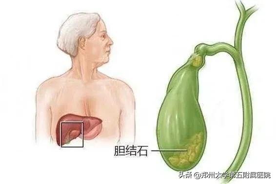 胆囊底部多发小结石说明石头多吗,胆囊结石石头在b超下不会移动